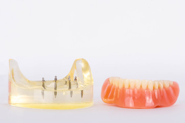 The mini-dental screw for retained lower complete denture
