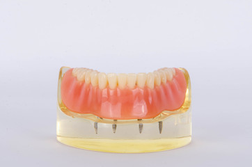 The mini-dental screw for retained lower complete denture