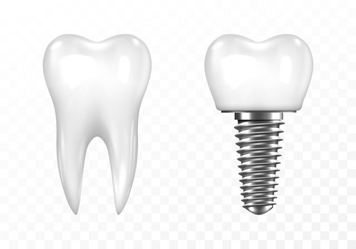 Human tooth and Dental implant on transparent background