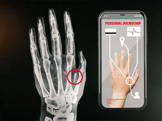 Radiography of a hand showing the personal microchip
