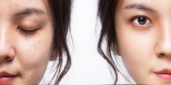 Comparison skin face, Closeup face of women before and after facial face care, Asian young girl face skin treatment.