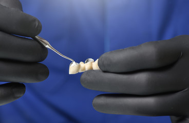 Dentist prepares a dental bridge for installation and applies a special paste of cement