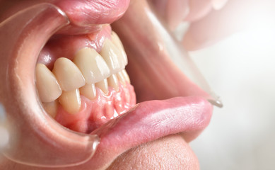 Dental mouth spreader and female teeth close-up.