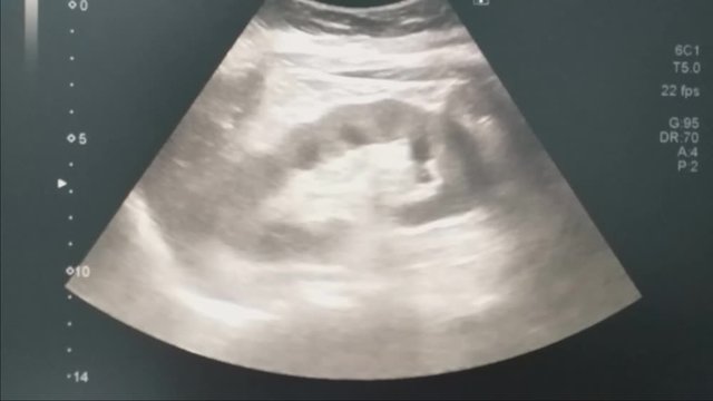 Whole abdomen ultrasound wave scan show image of kidney human for diagnostic exam the size, shape and location of the kidneys also be used to assess blood flow to the kidneys. Concept of medical.