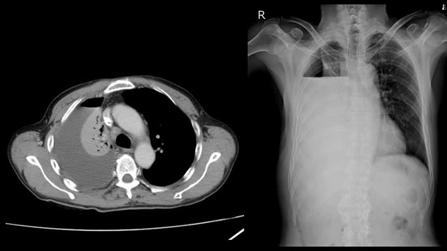 Chest x-ray Two views Severe right pleural effusion with hydropneumothorax. Compressive atelectasis of right lung