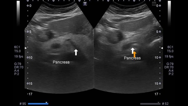 Blurry Ultrasound Whole : Abdomen Showing laarge gastric tumor of body and antrum with luminal narrowing of gastic antrum.Liver,GB,CBD,pancreas,spleen and both kidneys are normal.