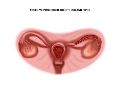 Illustration of the adhesive process in the uterus and tubes. Infertility