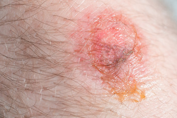 Fototapeta premium Scar of strong man on leg from closeup view