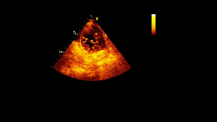 Image of the heart in gray-scale mode during transesophageal ultrasound.