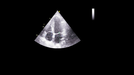 Image of the heart in gray-scale mode during transesophageal ultrasound.