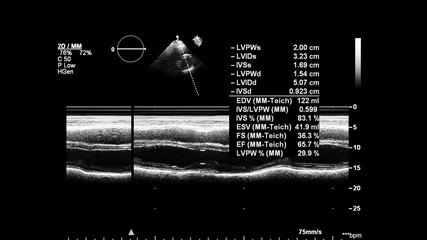 Image of the heart in gray-scale mode during transesophageal ultrasound.