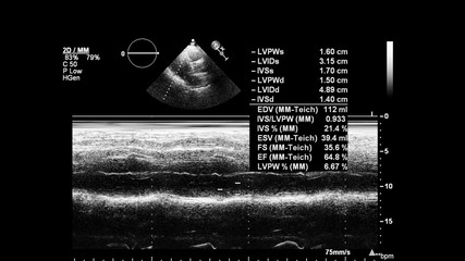 Image of the heart in gray-scale mode during transesophageal ultrasound.