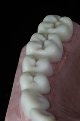 The wax up dental crown on model