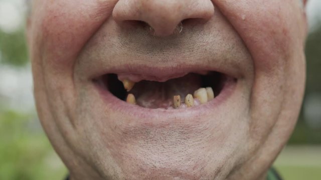 The man teeth fell out, yellow and black teeth hurt. Poor teeth condition, erosion, caries.