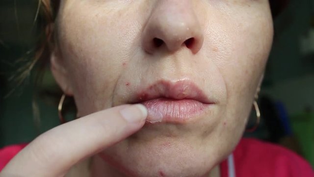 The woman smears the ointment on the cold sore herpes. Close-up.