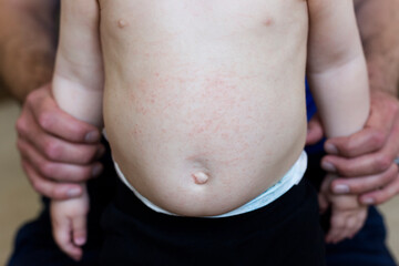 Belly of baby with Atopic Dermatitis (Eczema), showing typical itchy, red rash and excoriations from scratching
