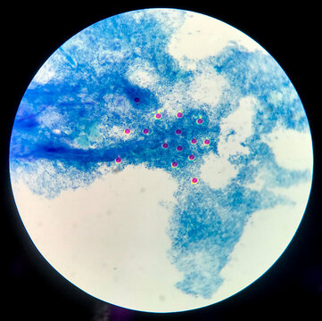 Red cell on blue background cryptococcus in HIV patients.