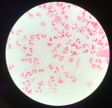 Slide show Gram negative diplococci in pus from penis .