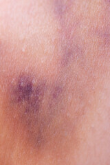 hematoma on the skin of the legs