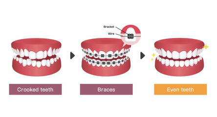 Dental braces process vector illustration