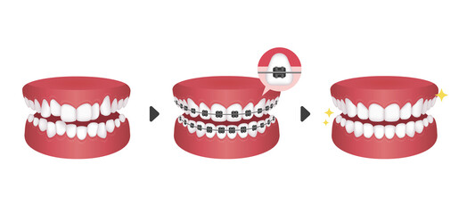 Dental braces process vector illustration / no text