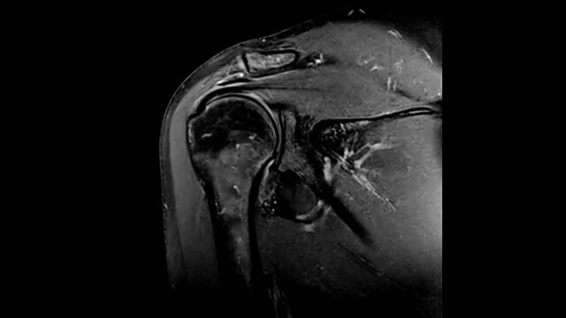 Magnetic resonance Imaging (MRI) of Shoulder cor PD TSE FAT SAT 1,5Tesla SIMENS