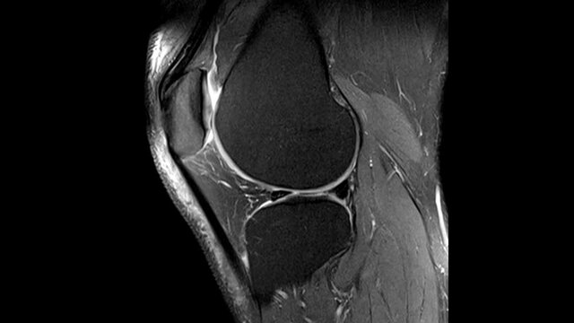 Magnetic Resonance Imaging MRI - Knee SAG PD fat sat