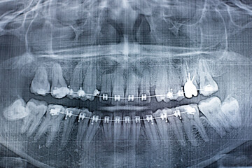X-ray photograph of human teeth with a braces system. Retarded Wisdom Tooth. Film noise effect - obrazy, fototapety, plakaty