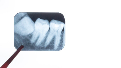 gloved dentist surgeon holds x-ray of lower retarded wisdom tooth. Film noise effect