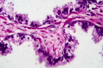 Prostate cancer, light micrograph