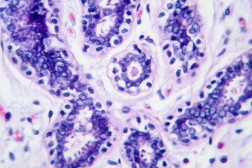 Breast cancer, light micrograph