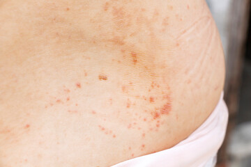 Skin disease prickly heat rash or miliaria on back skin of asian woman. Healthcare skin cause for outdoor work in sunny with hot weather and have sweat. Dermatologist and treatment medication concept.