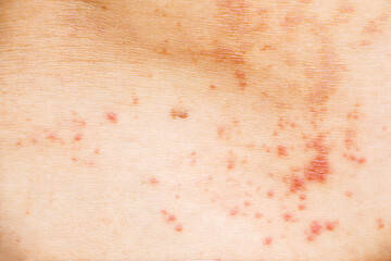 Skin disease prickly heat rash or miliaria on back skin of asian woman. Healthcare skin cause for...