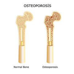 Bone structure in osteoporosis patients