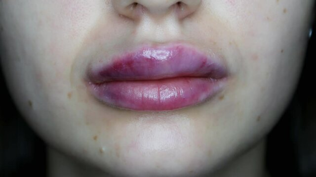 Macro close-up of swollen lips after injections of hyaluron, lips augmentation
