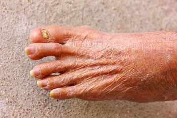 dry skin with toenail fungus on old woman leg