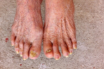 dry skin with toenail fungus on old woman leg