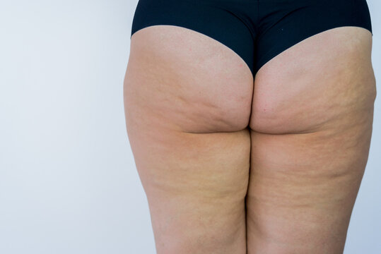 Celulite on womans hips with butt acne