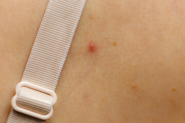Closeup skin with acne moles and red spots.