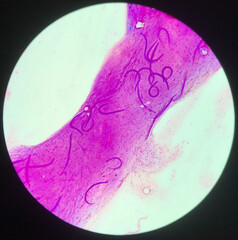strongyloides stercoralis parasit in human.