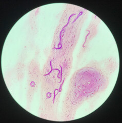 strongyloides stercoralis parasit in human.