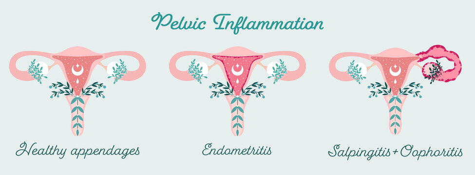 Pelvic Inflammation - Floral Infographic. Endometritis, Oophoritis, Salpingitis. Women health. Edema of uterus - Patient-friendly scheme. Gynecological Problems - Neutral medical diagram
