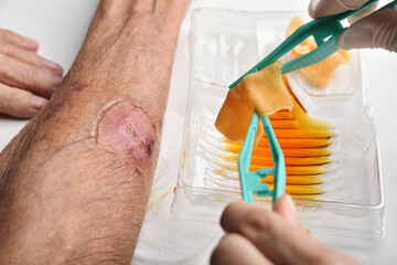 Wound dressing, Doctor cleaning and wash infected wound in chronic diabetes patient with normal...