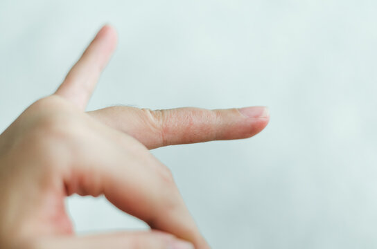 Details of a finger recovering from dyshidrosis.