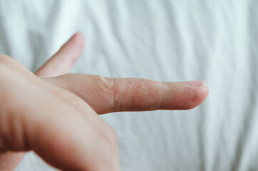 Details of a finger recovering from dyshidrosis.