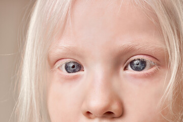 close-up photo of beautiful blue eyes of albino child girl looking side. charming look, natural beauty concept - obrazy, fototapety, plakaty