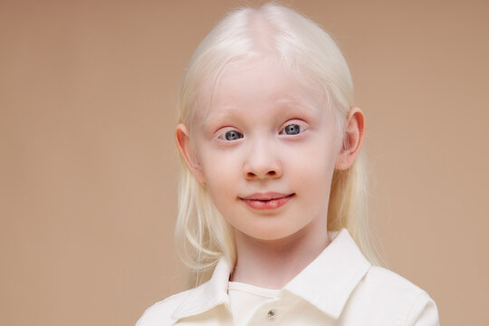 close-up portrait of little caucasian girl with albinism syndrome. abnormal deviations. unusual appearance. skin abnormality