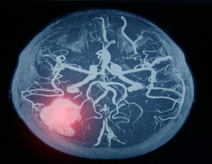 MRA brain or Magnetic resonance angiography image ( MRA ) of cerebral artery in the  hemorrhage in...