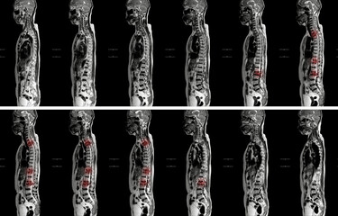 MRI OF THORACOLUMBAR SPINE IMPRESSION:  Moderate pathological compression of T11 and L2 levels with...