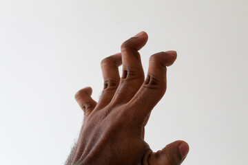 swan neck deformity fingers due to rheumatoid arthritis - obrazy, fototapety, plakaty